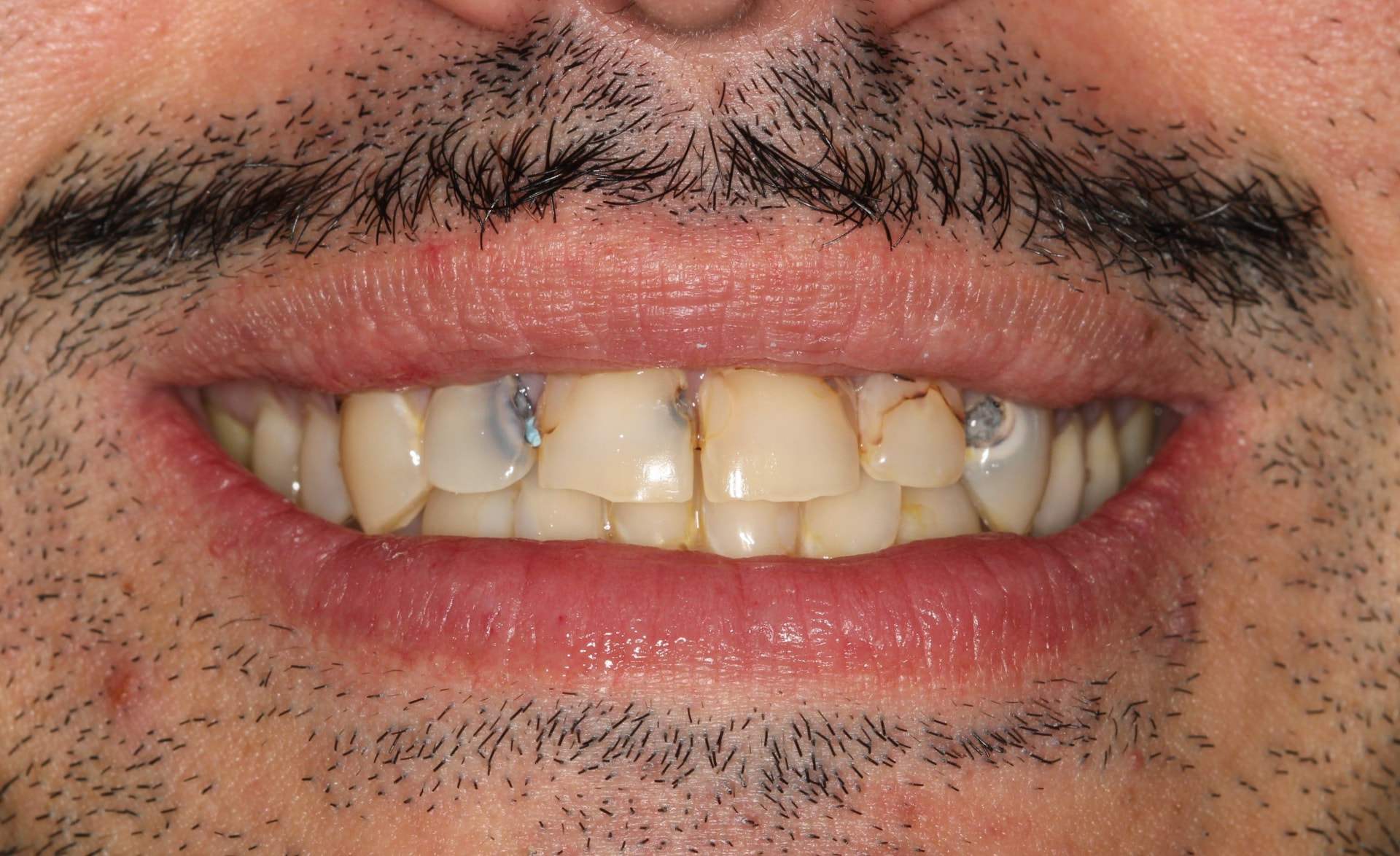 6 Upper Veneers before treatment