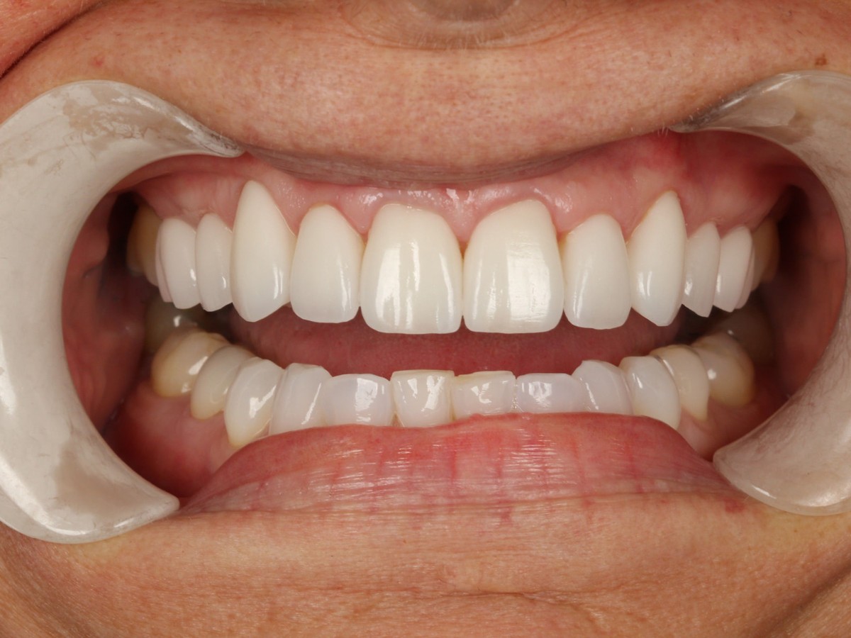Full Mouth Rehabilitation after treatment