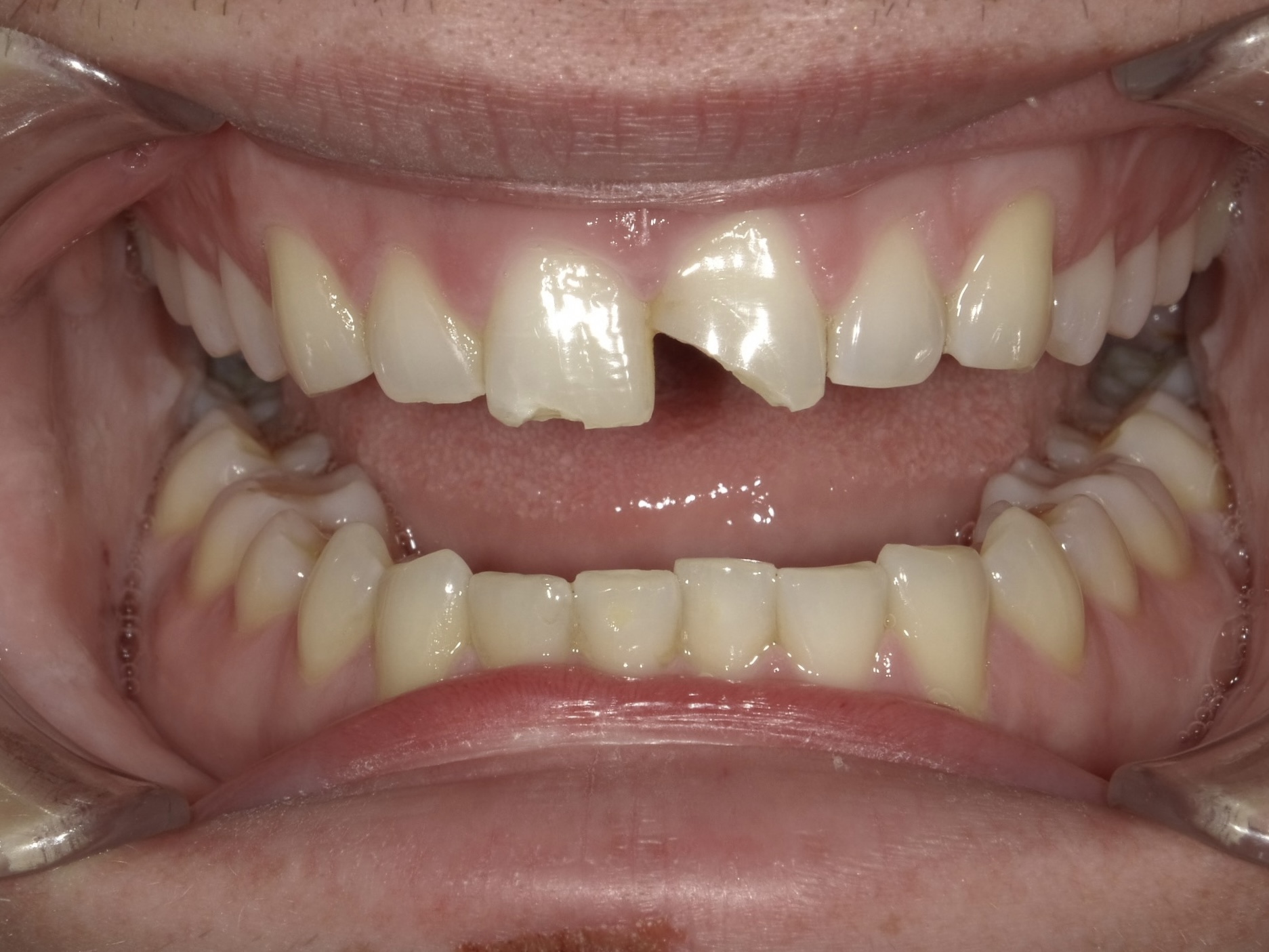 Composite Bonding after treatment