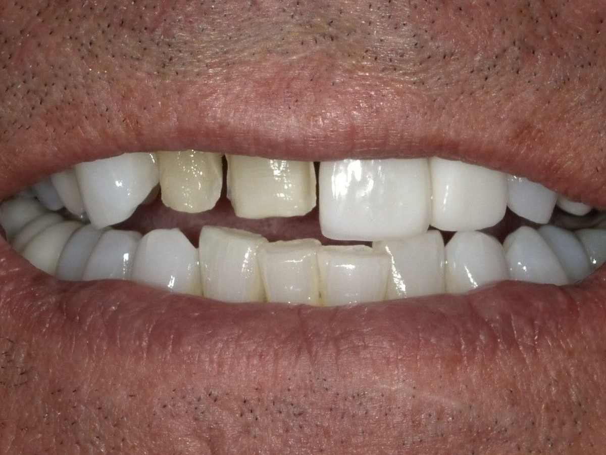 Smile Refresh before treatment