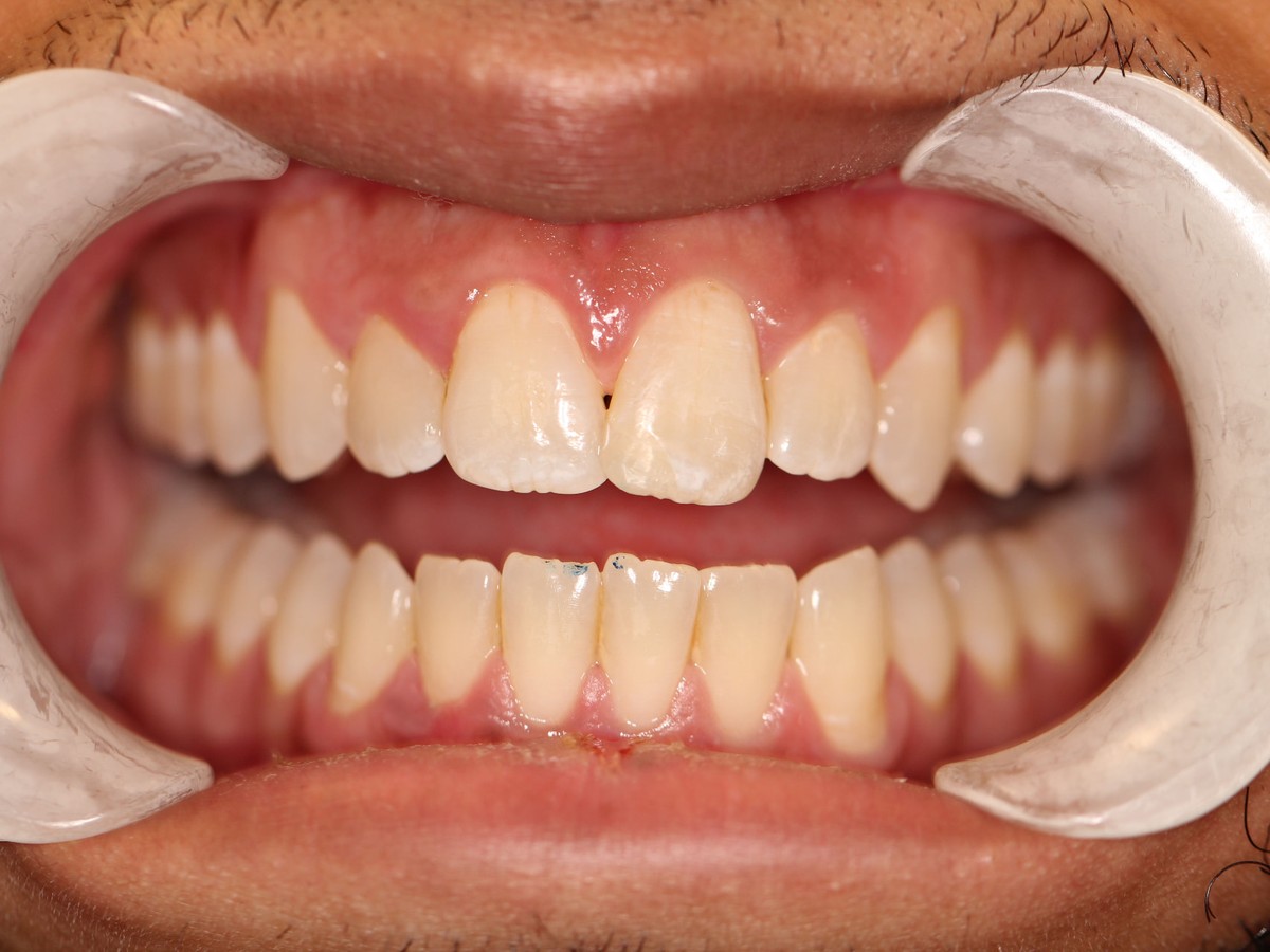 Cosmetic Bonding before treatment