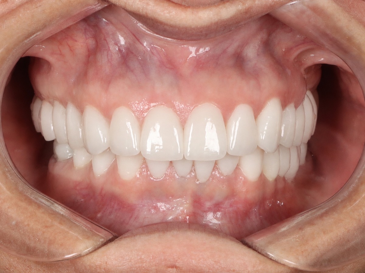 Full Arch Restoration after treatment