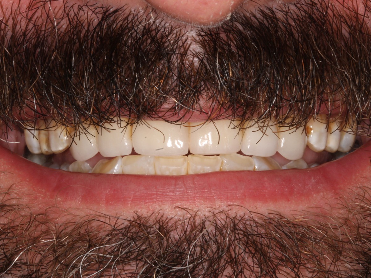 Full Upper Veneers before treatment