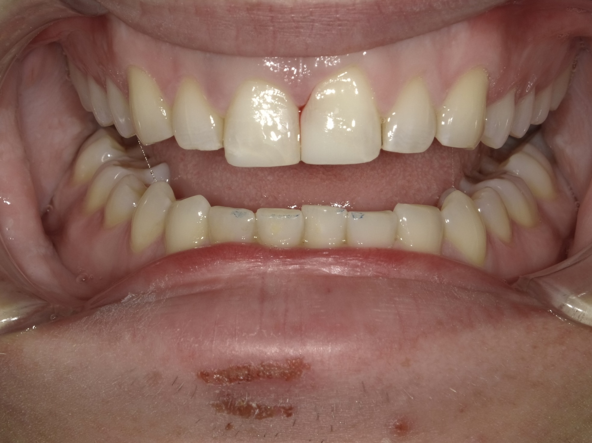 Composite Bonding before treatment