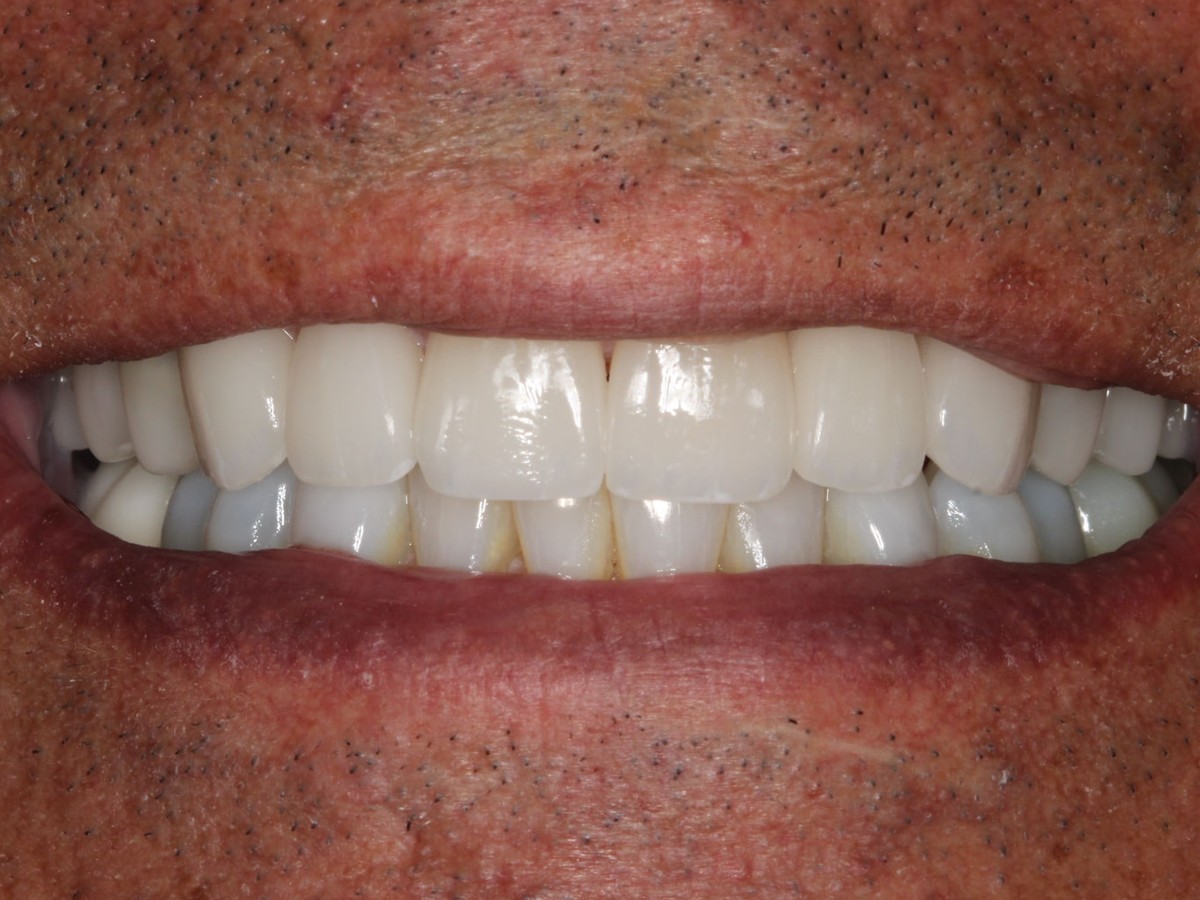 Smile Refresh after treatment