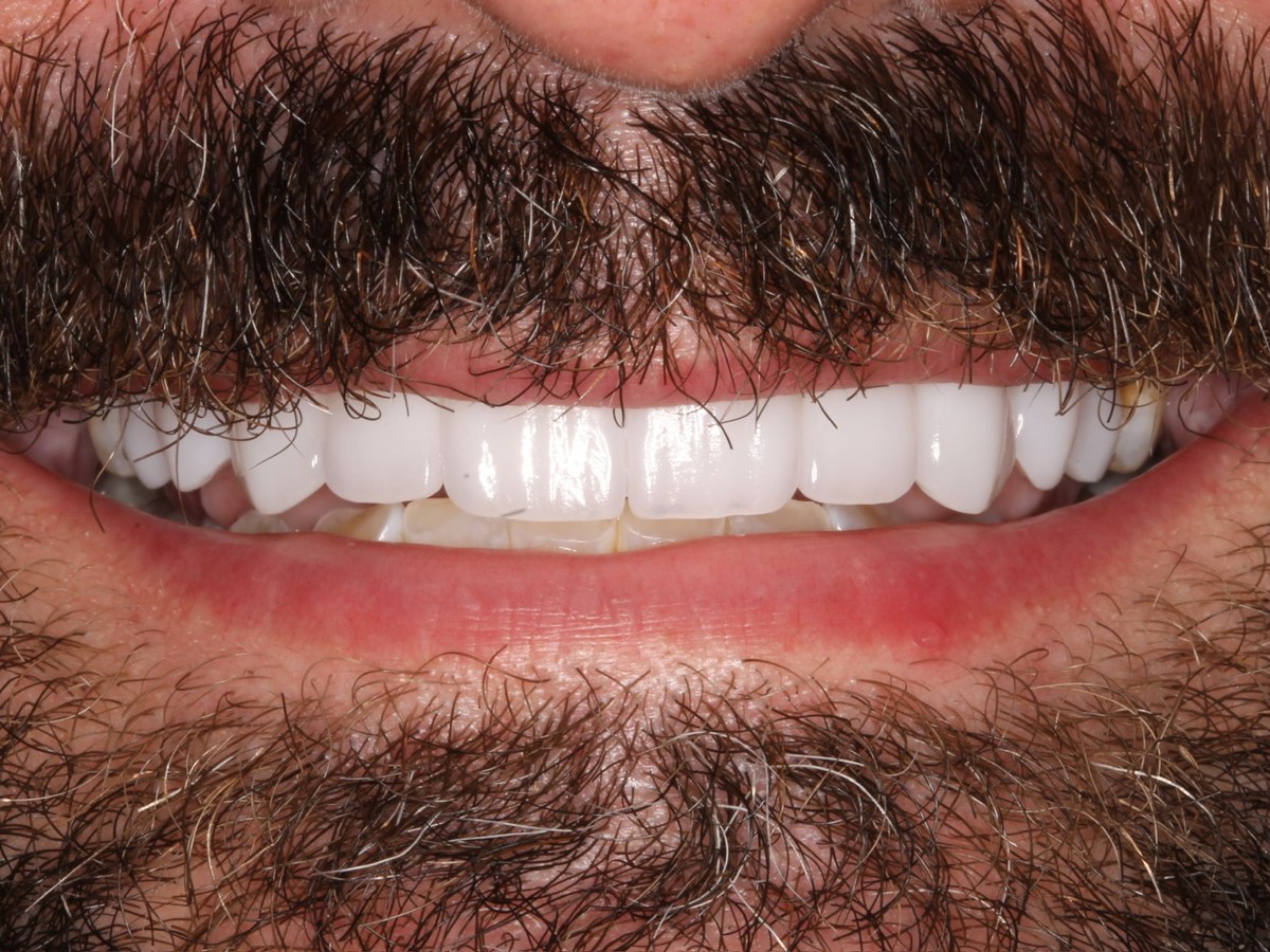 Full Upper Veneers after treatment